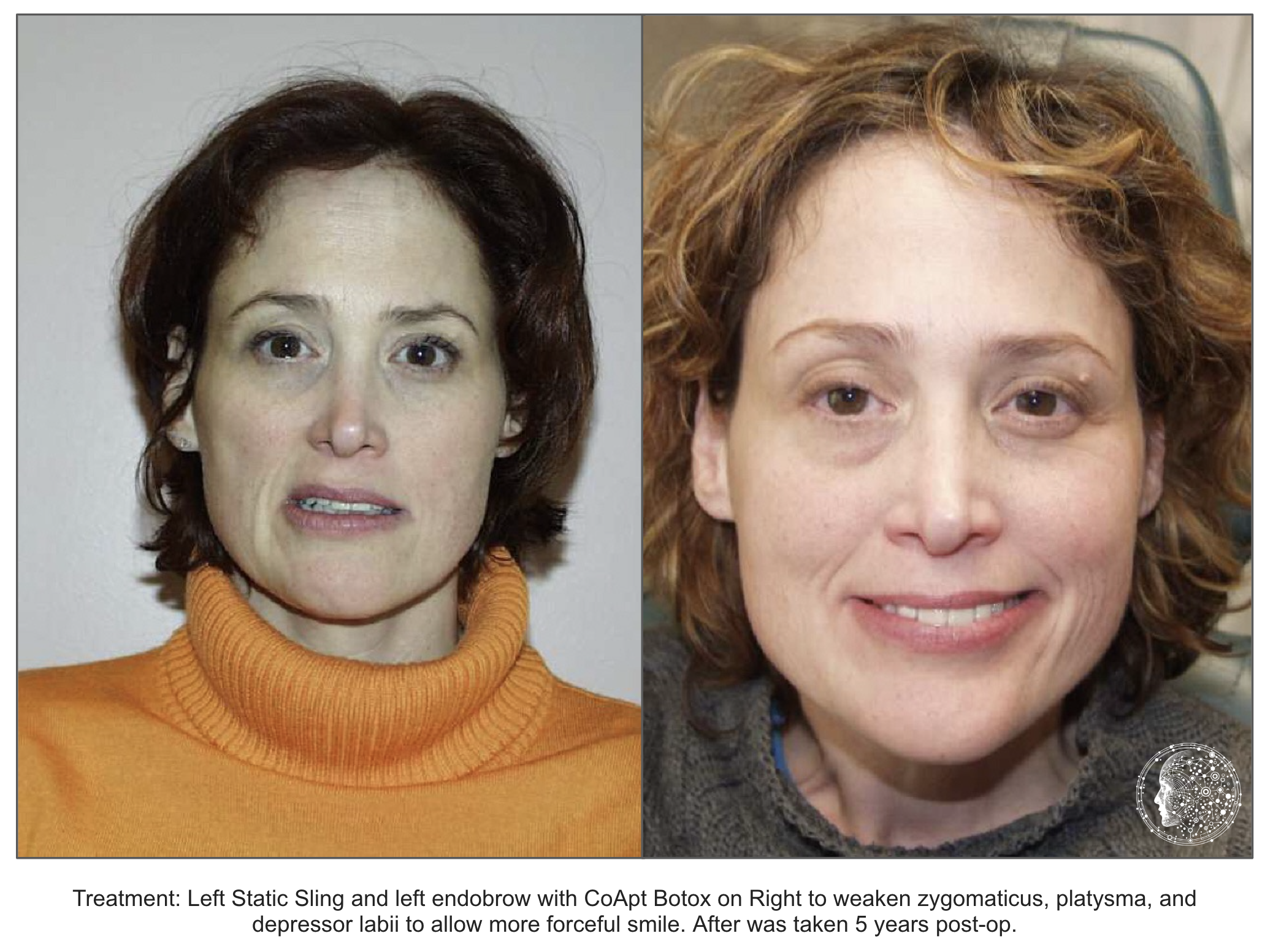 Facial Paralysis Specialists - Before After - Static Sling